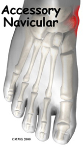 Accessory%20Navicular.jpg