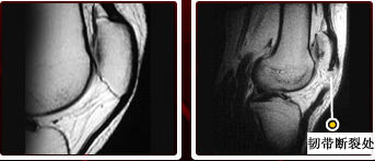 左图是正常人的膝盖韧带，右图标示处就是罗纳尔多这次韧带断裂的部位