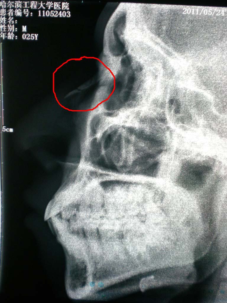 鼻骨骨折x线图片图片